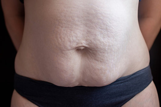 What Is Diastasis Recti—and How Do I Fix It?