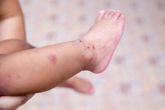 A baby's foot with the telltale blisters of hand-foot-mouth disease